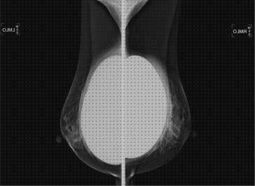 Las mejores protesis silicona mamografia con protesis de silicona