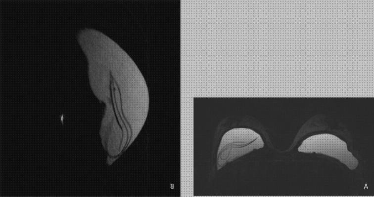 Opiniones de protesis silicona mamografia con protesis de silicona