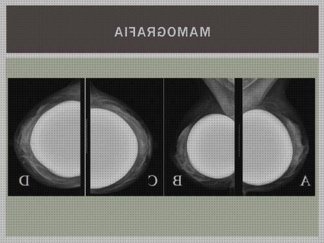 Los mejores 1 Mamografia Con Protesis De Siliconas