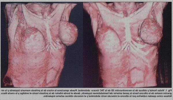 Las mejores protesis silicona protesis de gel de silicona