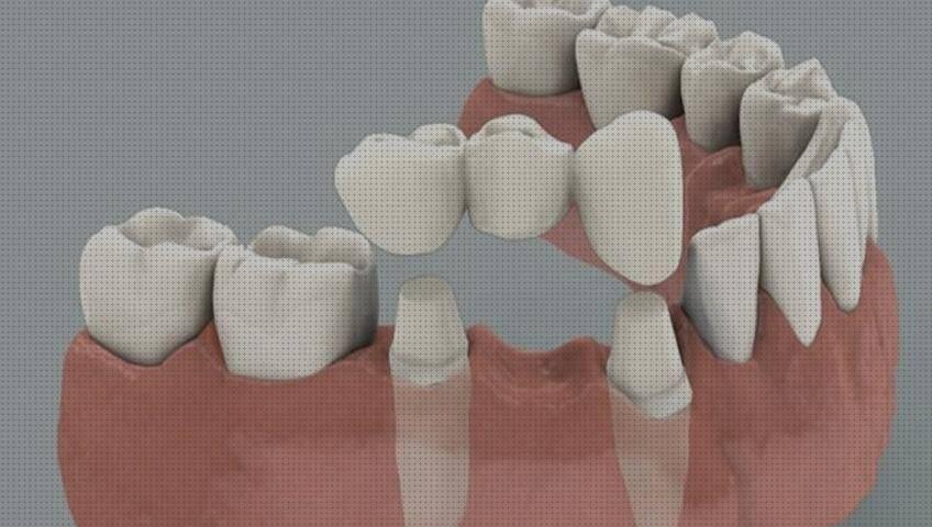 Opiniones de las 10 mejores Protesis De Siliconas Dientes